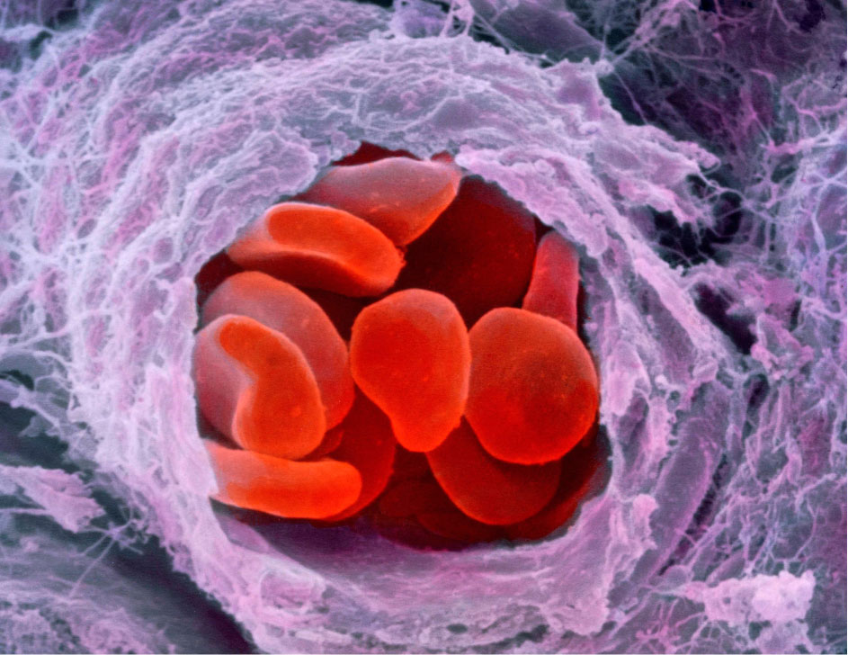 Haemophilia and Gene Therapeutics